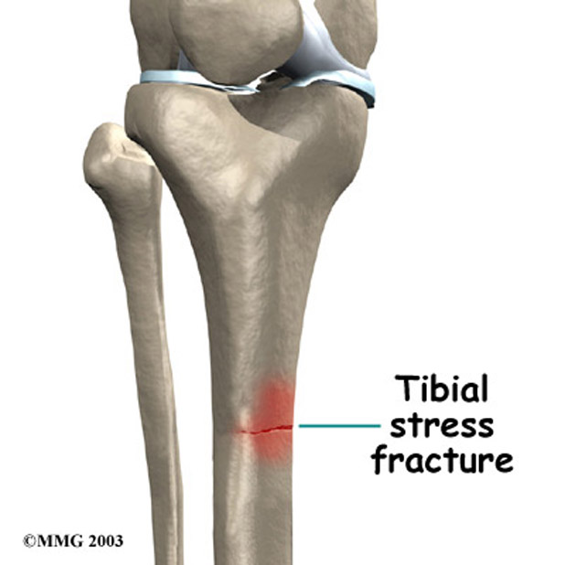 7 Ways to Prevent Stress Fractures 3 A stress fracture