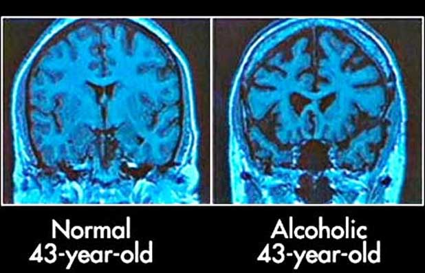 The Harmful Effects of Alcohol on Health 6 brain alcohol The Harmful Effects of Alcohol on Health - 5