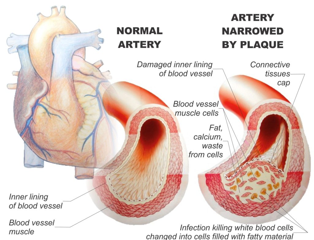 1 20 1 Blocked Arteries: The Main Symptoms and Warning Signs - 3 blocked arteries symptoms