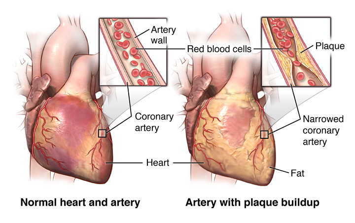 2 2 1 Blocked Arteries: The Main Symptoms and Warning Signs - 1 blocked arteries symptoms