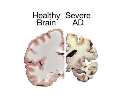 23 2 1 Alzheimer's Disease: Causes, Symptoms and Available Treatments - 5 alzheimer's disease