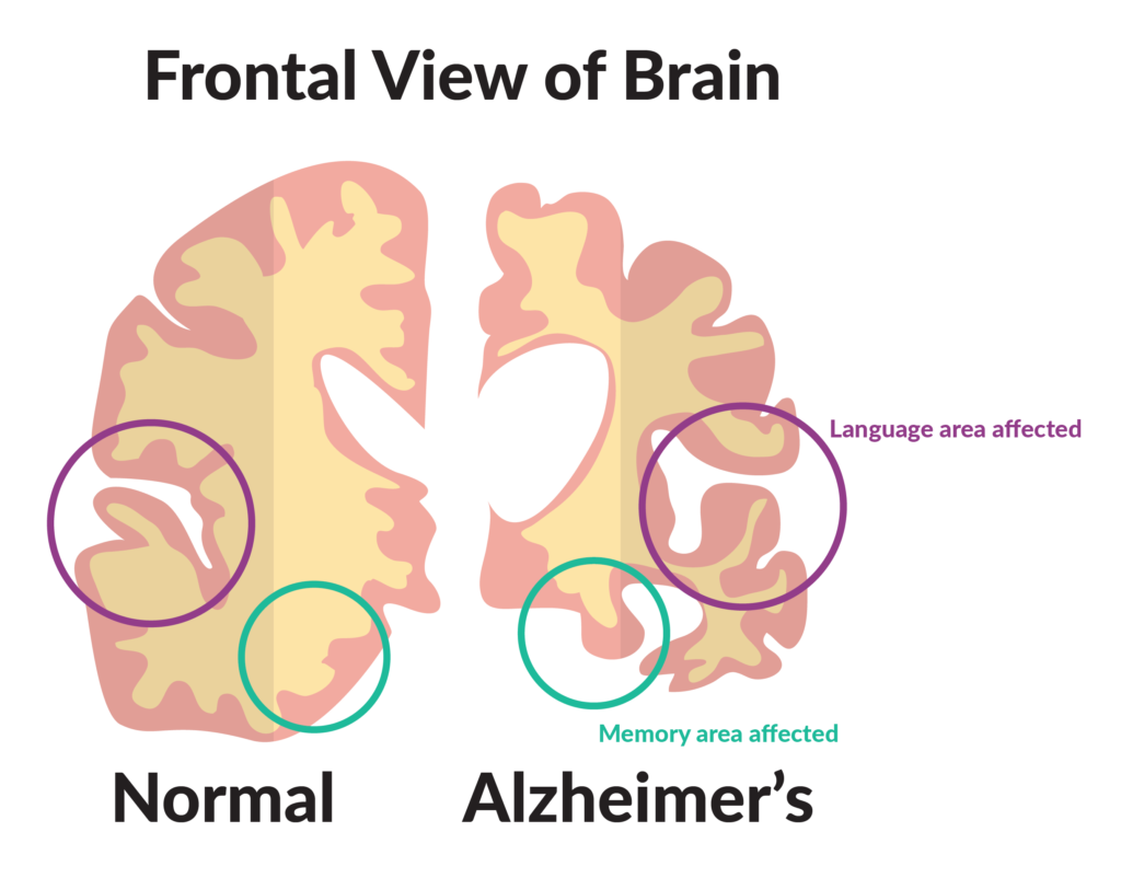 3 2 Alzheimer's Disease: Causes, Symptoms and Available Treatments - 3 alzheimer's disease