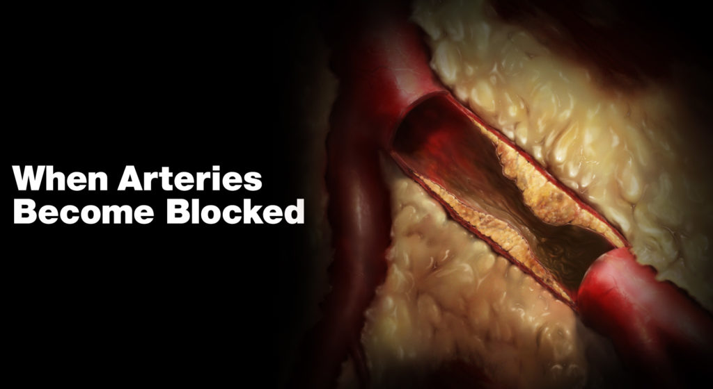 5 22 1 Blocked Arteries: The Main Symptoms and Warning Signs - 5 blocked arteries symptoms