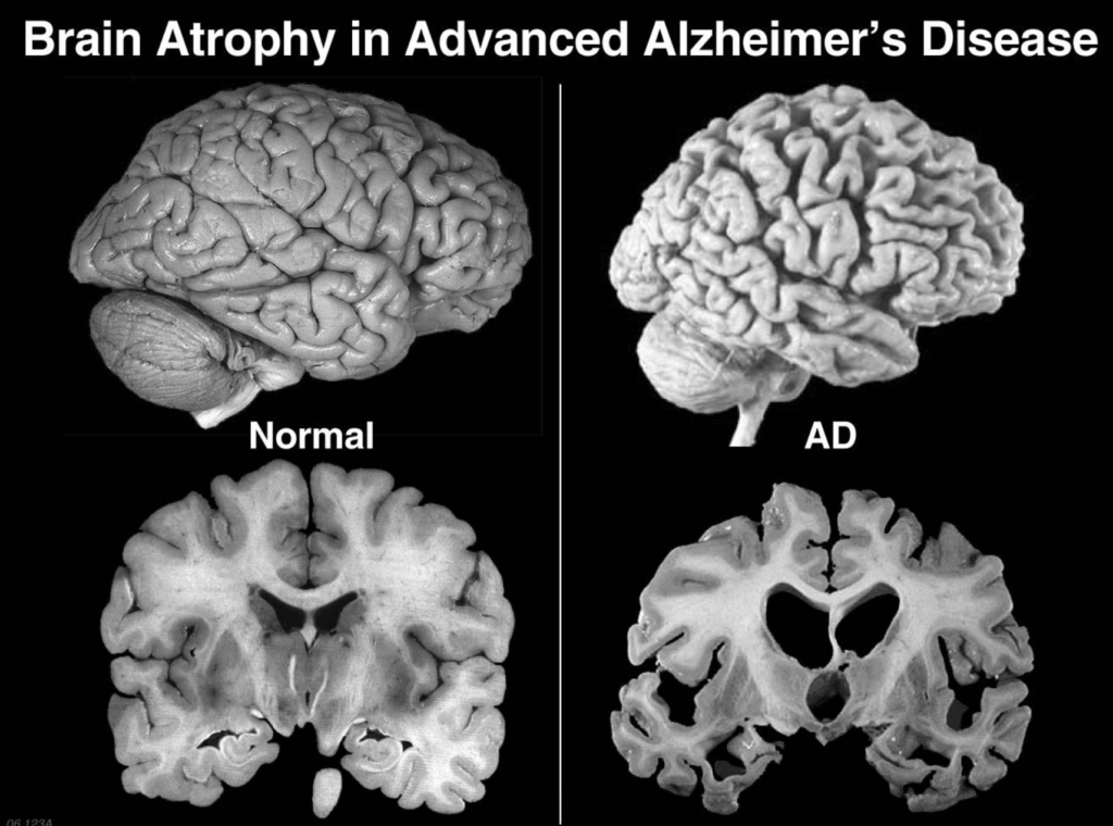 Dramatic Progress against Alzheimer 3 9 1 Dramatic Progress against Alzheimer - 2 dramatic progress alzheimer