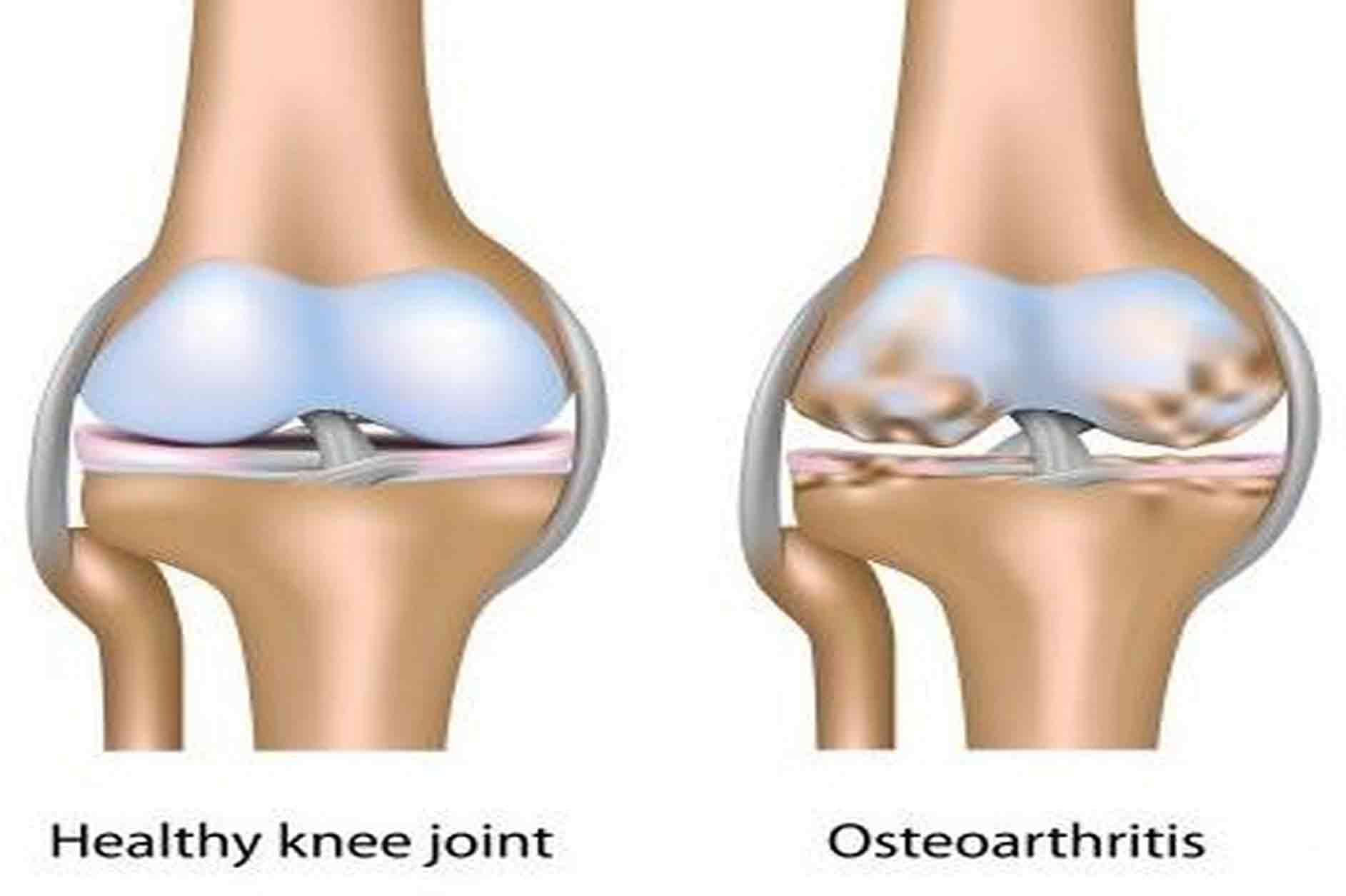 Key Factors that Increase Your Risk of Osteoarthritis 1 1 10 1 Key Factors that Increase Your Risk of Osteoarthritis - 1 key factors increase risk osteoarthritis