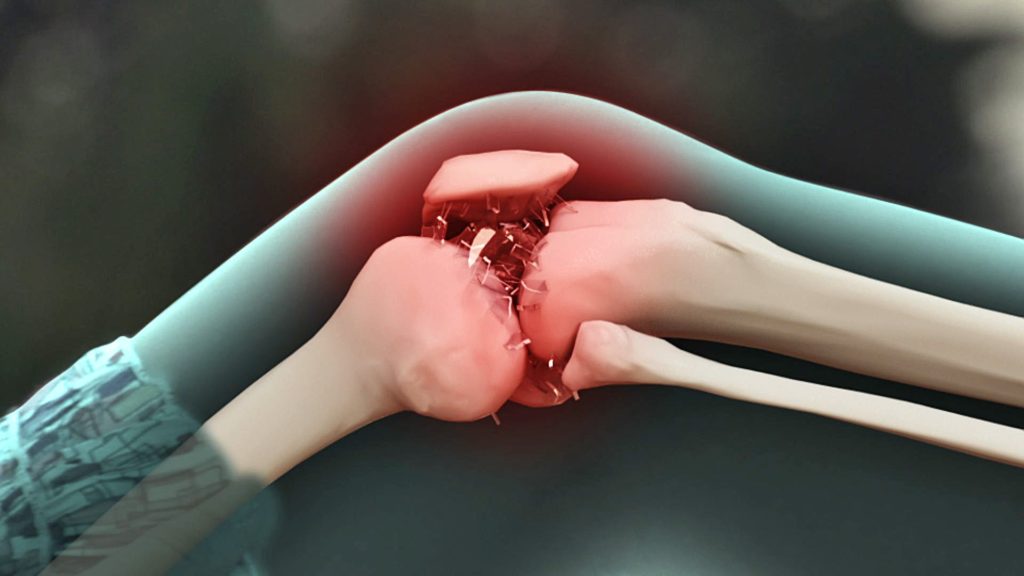 Key Factors that Increase Your Risk of Osteoarthritis 8 10 11 1 Key Factors that Increase Your Risk of Osteoarthritis - 8 key factors increase risk osteoarthritis