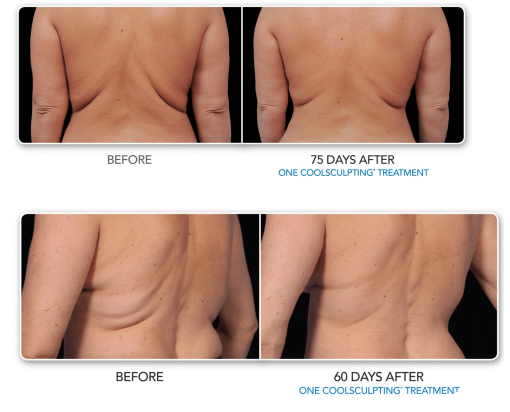 cool sculpting flat defined cold belly