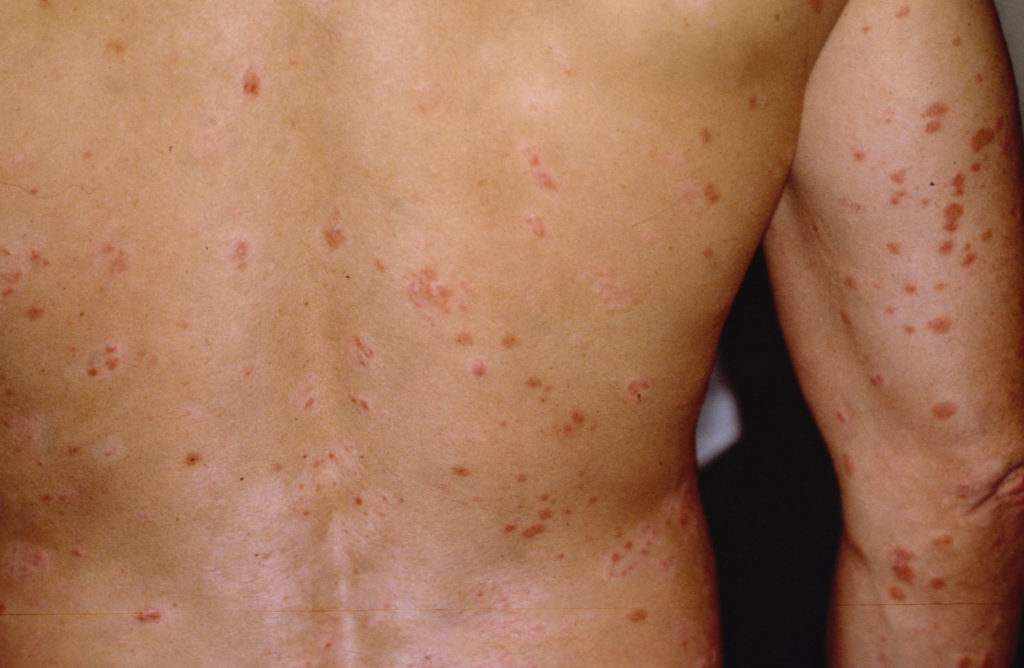 psoriasis skin disease