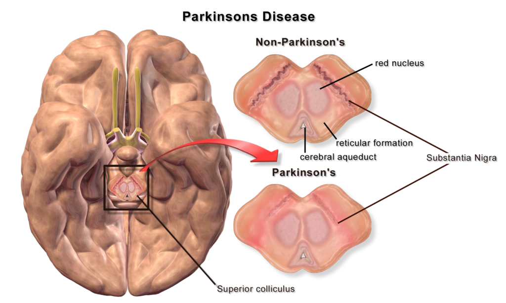 Parkinson's Disease: Symptoms, Causes and Treatment 2 parkinsons disease symptoms causes treatment