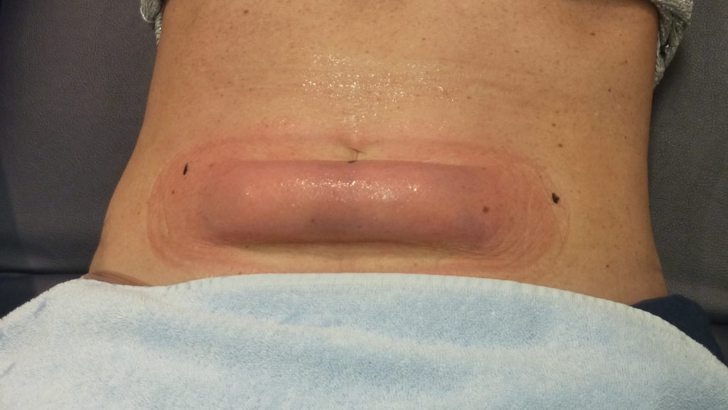 cool sculpting flat defined cold belly