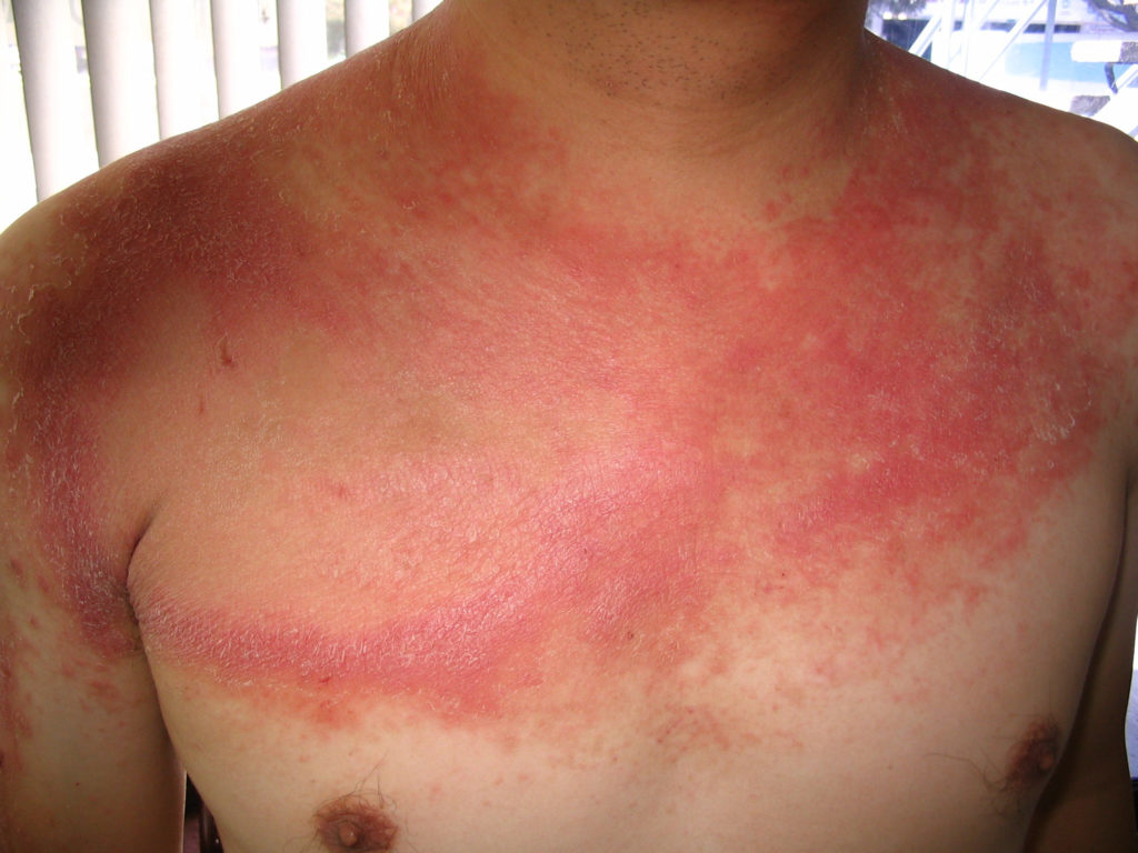 psoriasis skin disease