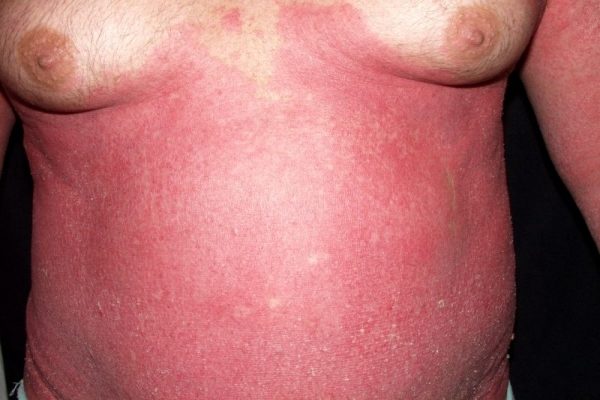 psoriasis skin disease
