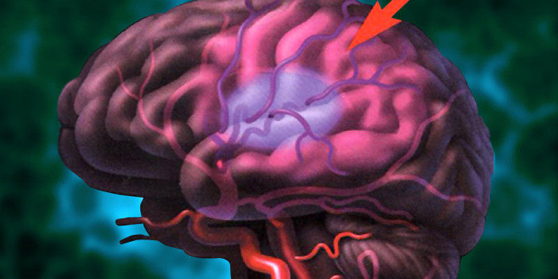 Stroke: Causes, Symptoms, Diagnosis, and Treatment 5 stroke real danger behind serious disease