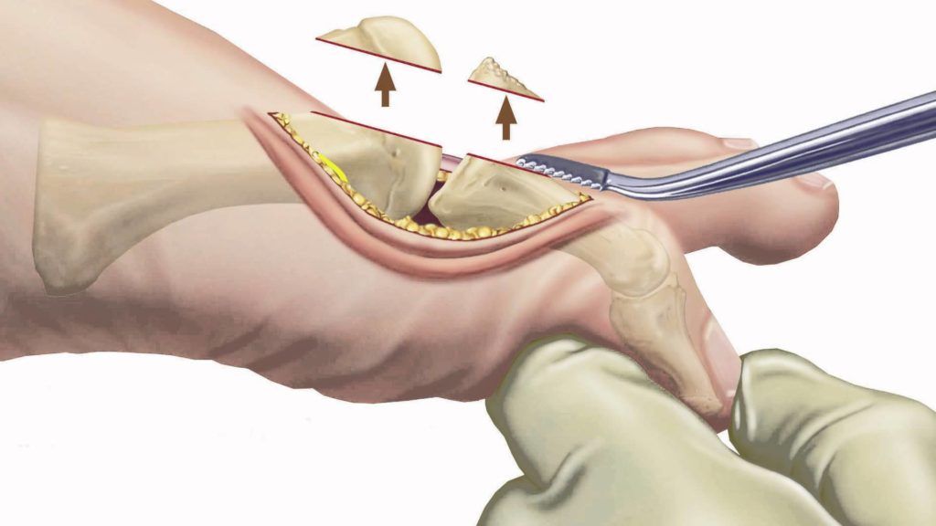 Arthritis Disease: Causes, Symptoms and Treatments 2 Arthritis Disease