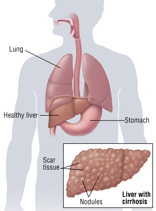 Cirrhosis Symptoms
