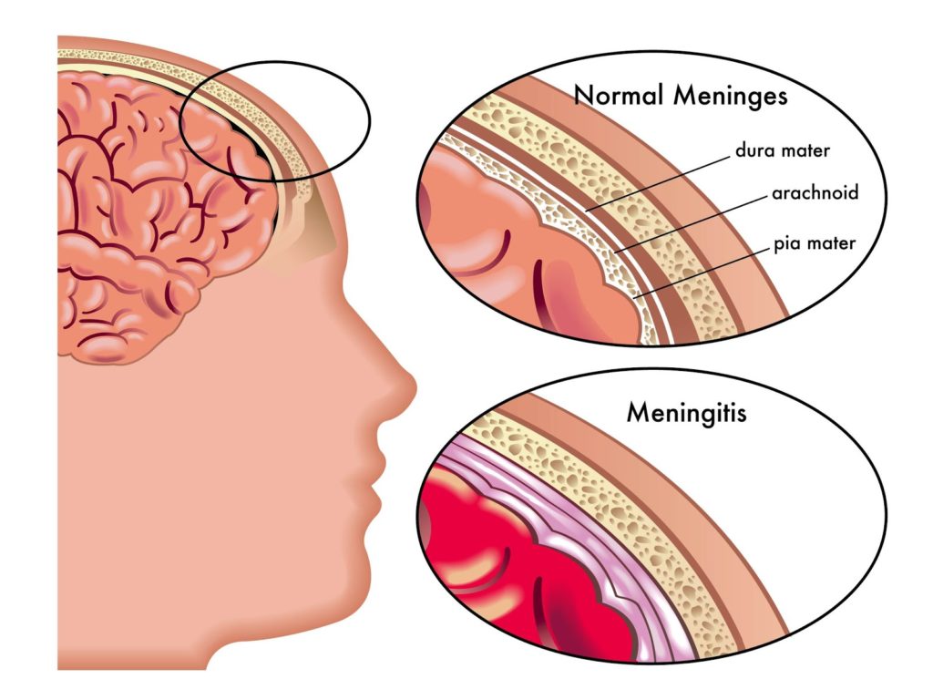 meningitis disease symptoms prevention possible treatments