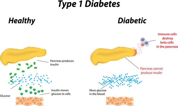 The Hidden Facts of Diabetes and Its Complications 2 diabetes facts diabetes complications