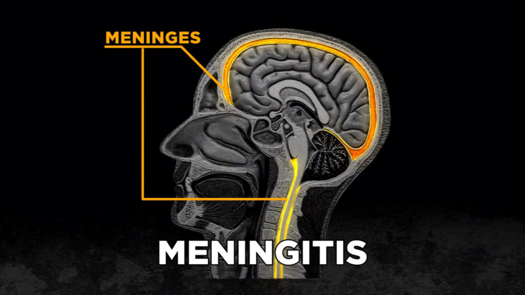 meningitis disease symptoms prevention possible treatments