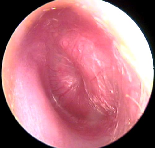 Otitis Media Infection: Hidden Facts 1 otitis media infection hidden facts viral infection