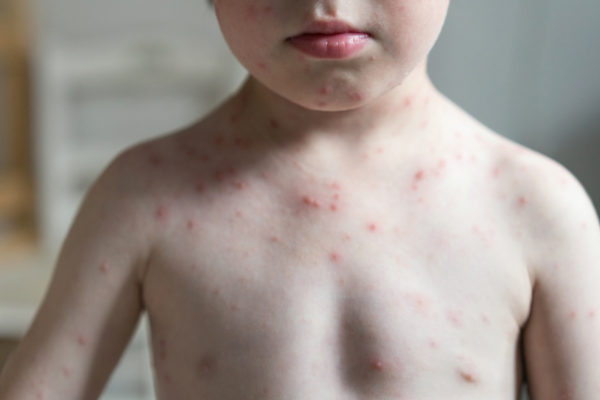 Chickenpox virus 2 Measles Viral Infection: Preventive Measures and Protection - 1 Measles Viral Infection