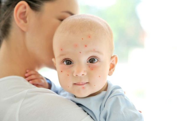 Chickenpox virus 3 Measles Viral Infection: Preventive Measures and Protection - 2 Measles Viral Infection