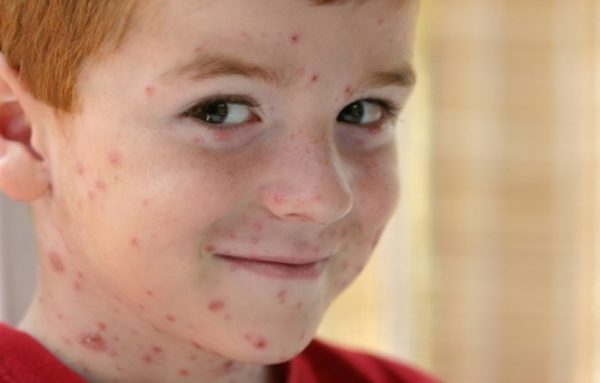 Chickenpox virus Chickenpox Viral Infection: Causes, Symptoms and Prevention of Your Child - 1 Chickenpox Viral Infection
