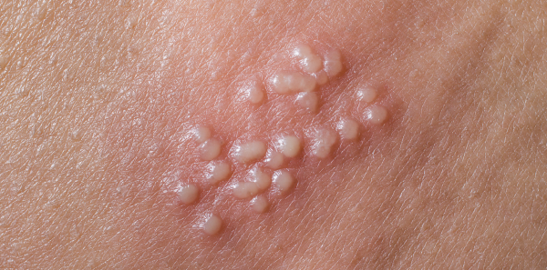 Genital Herpes: Overview, Symptoms and Treatments 1 Genital Herpes Genital Herpes: Overview, Symptoms and Treatments - 1 Genital Herpes