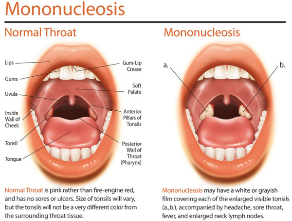 Mononucleosis Disease: Causes, Symptoms and Prevention 1 Mononucleosis Disease Mononucleosis Disease: Causes, Symptoms and Prevention - 1 Mononucleosis Disease
