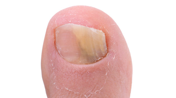 Onychomycosis Infection: Causes, Symptoms, Treatments and Possible Preventions 1 Onychomycosis Infection Onychomycosis Infection: Causes, Symptoms, Treatments and Possible Preventions - 1 Onychomycosis Infection