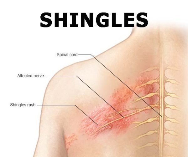 Shingles Viral Infection: Main Causes Finishedand How to Protect Yourself from It 1 Shingles Viral Infection Shingles Viral Infection: Main Causes Finishedand How to Protect Yourself from It - 1 Shingles Viral Infection
