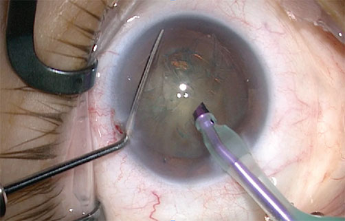 cataract surgery Cataract Surgery: Causes, Symptoms and Possible Treatments - 6 Cataract Surgery