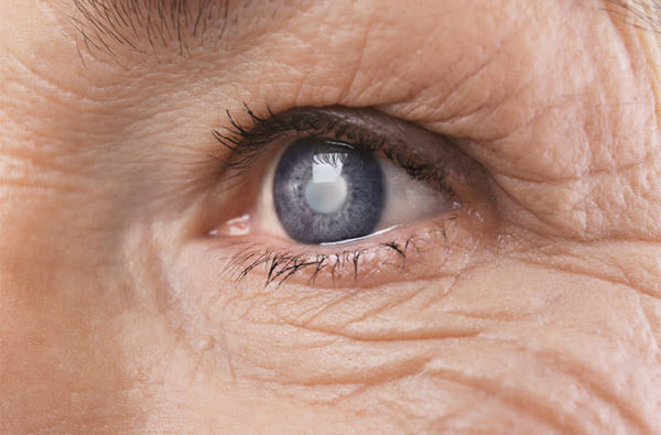 eye cataract Cataract Surgery: Causes, Symptoms and Possible Treatments - 1 Cataract Surgery