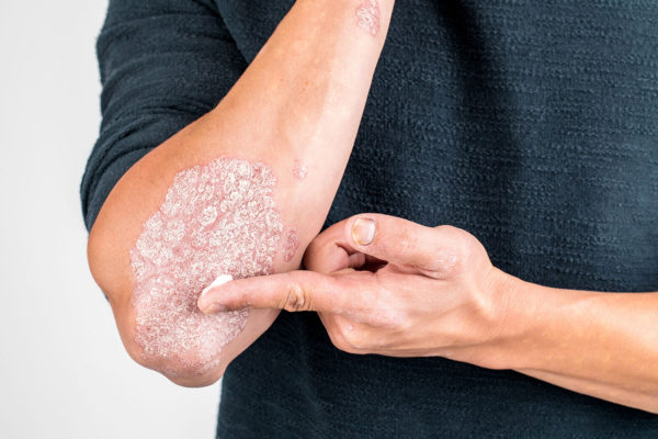 Psoriasis What Is Psoriasis? Basic Symptoms and Types - 1 Psoriasis
