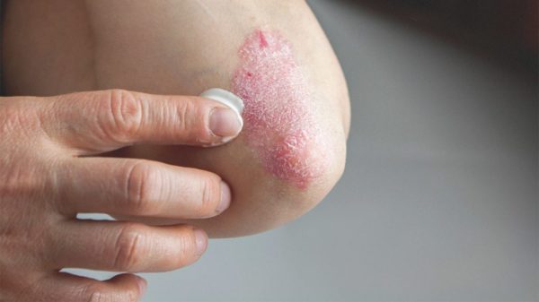 Psoriasis treatment What Is Psoriasis? Basic Symptoms and Types - 3 Psoriasis